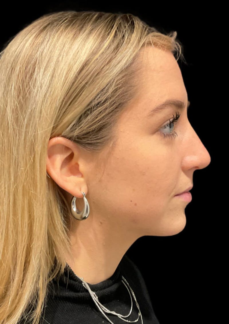 Ultrasonic Rhinoplasty Before & After Gallery - Patient 206813 - Image 1