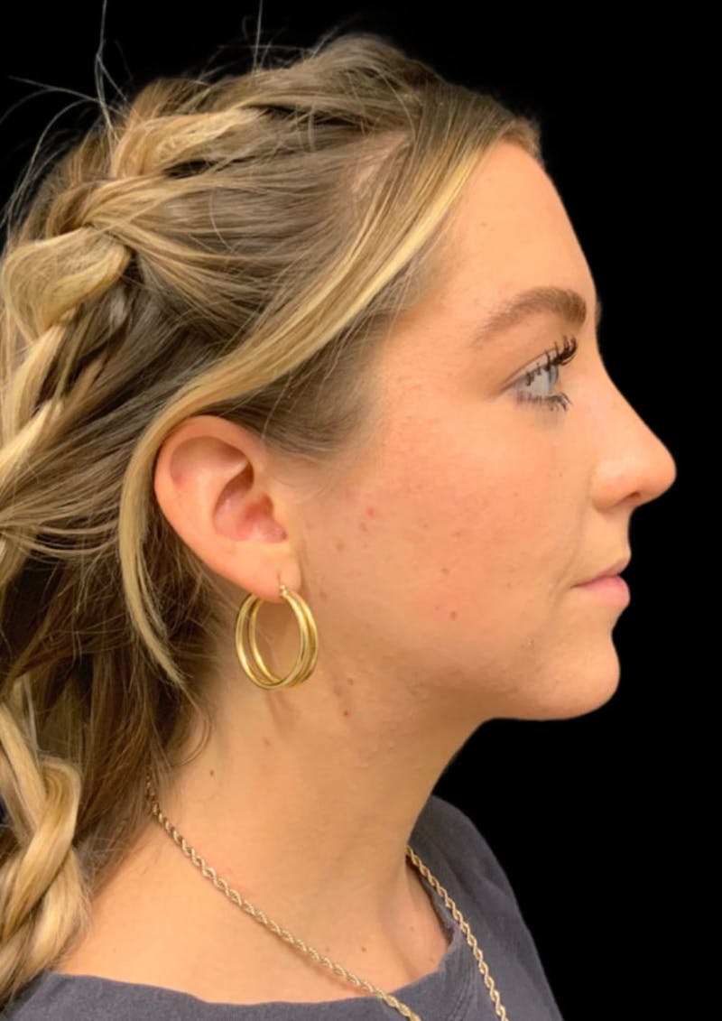 Ultrasonic Rhinoplasty Before & After Gallery - Patient 206813 - Image 2