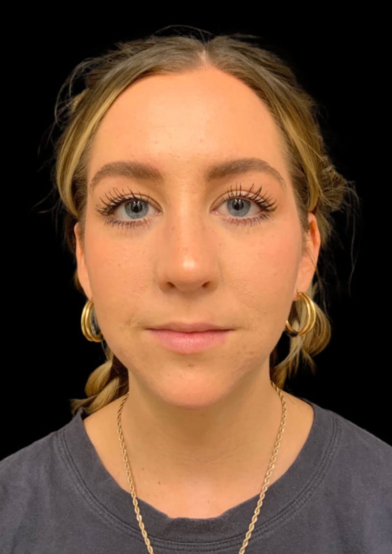 Ultrasonic Rhinoplasty Before & After Gallery - Patient 206813 - Image 4