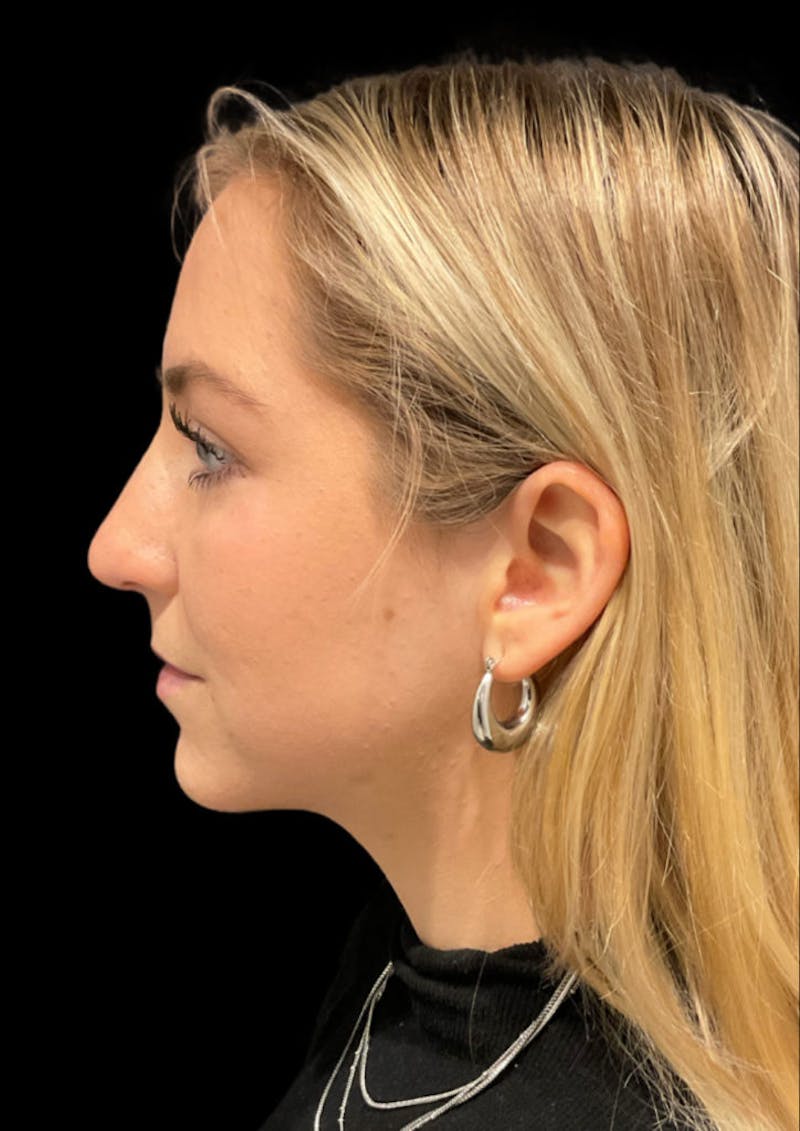 Ultrasonic Rhinoplasty Before & After Gallery - Patient 206813 - Image 9