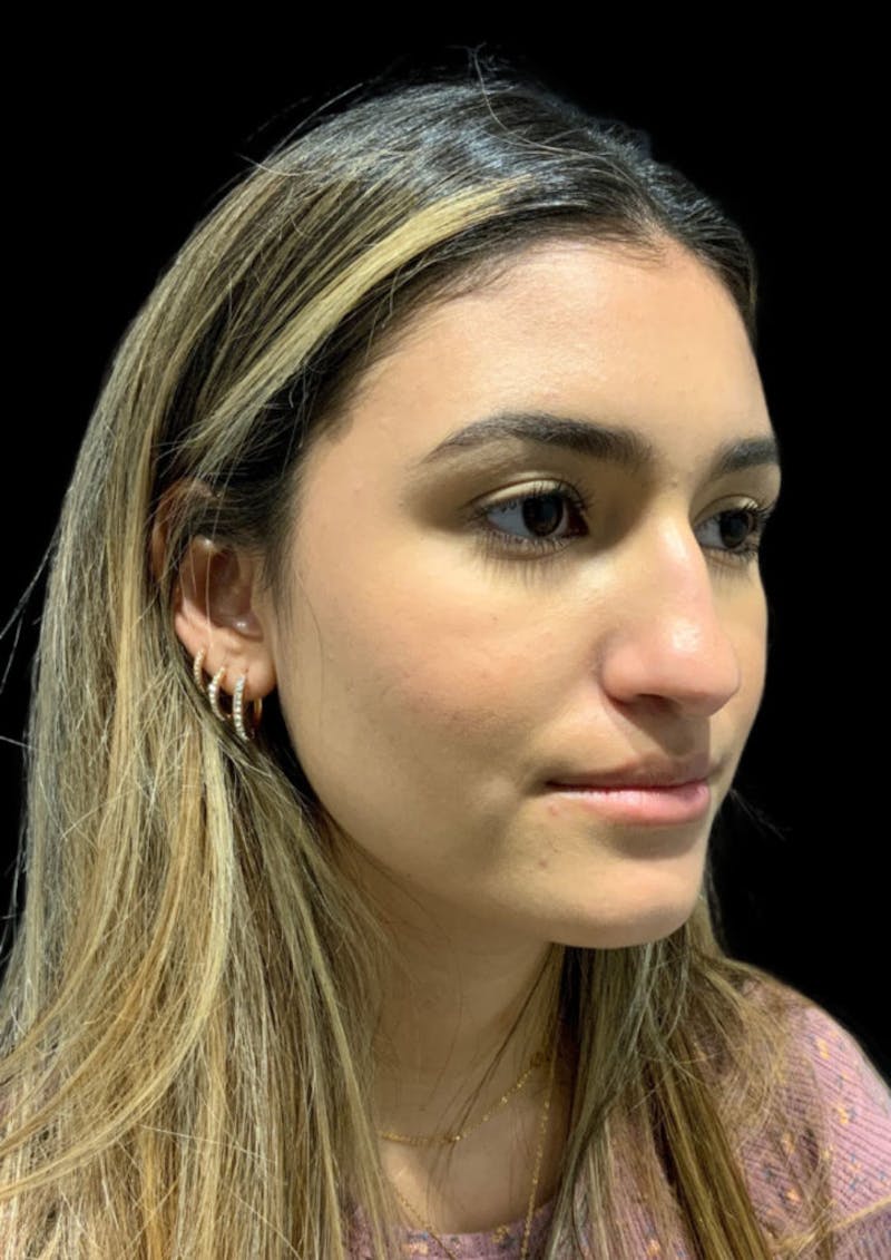 Ultrasonic Rhinoplasty Before & After Gallery - Patient 348848 - Image 5