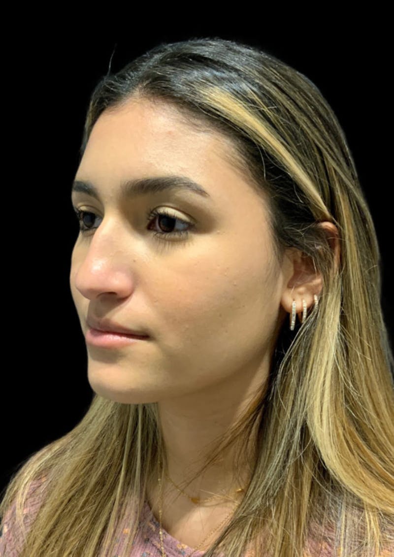 Ultrasonic Rhinoplasty Before & After Gallery - Patient 348848 - Image 7