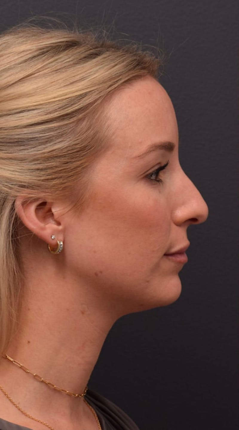 Ultrasonic Rhinoplasty Before & After Gallery - Patient 432674 - Image 1