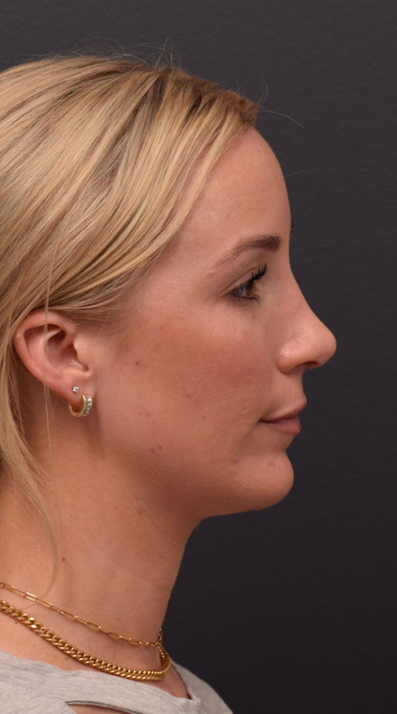 Ultrasonic Rhinoplasty Before & After Gallery - Patient 432674 - Image 2