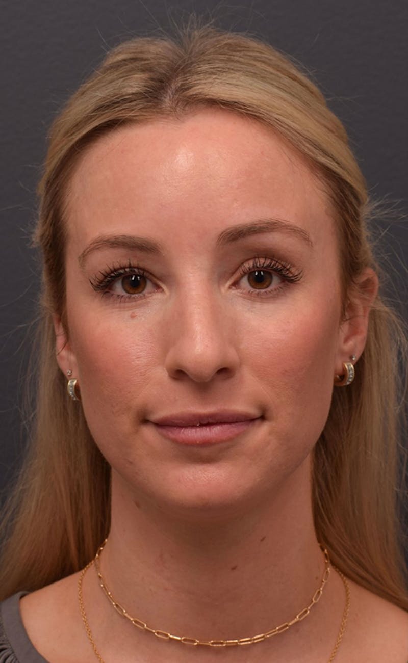 Ultrasonic Rhinoplasty Before & After Gallery - Patient 432674 - Image 3
