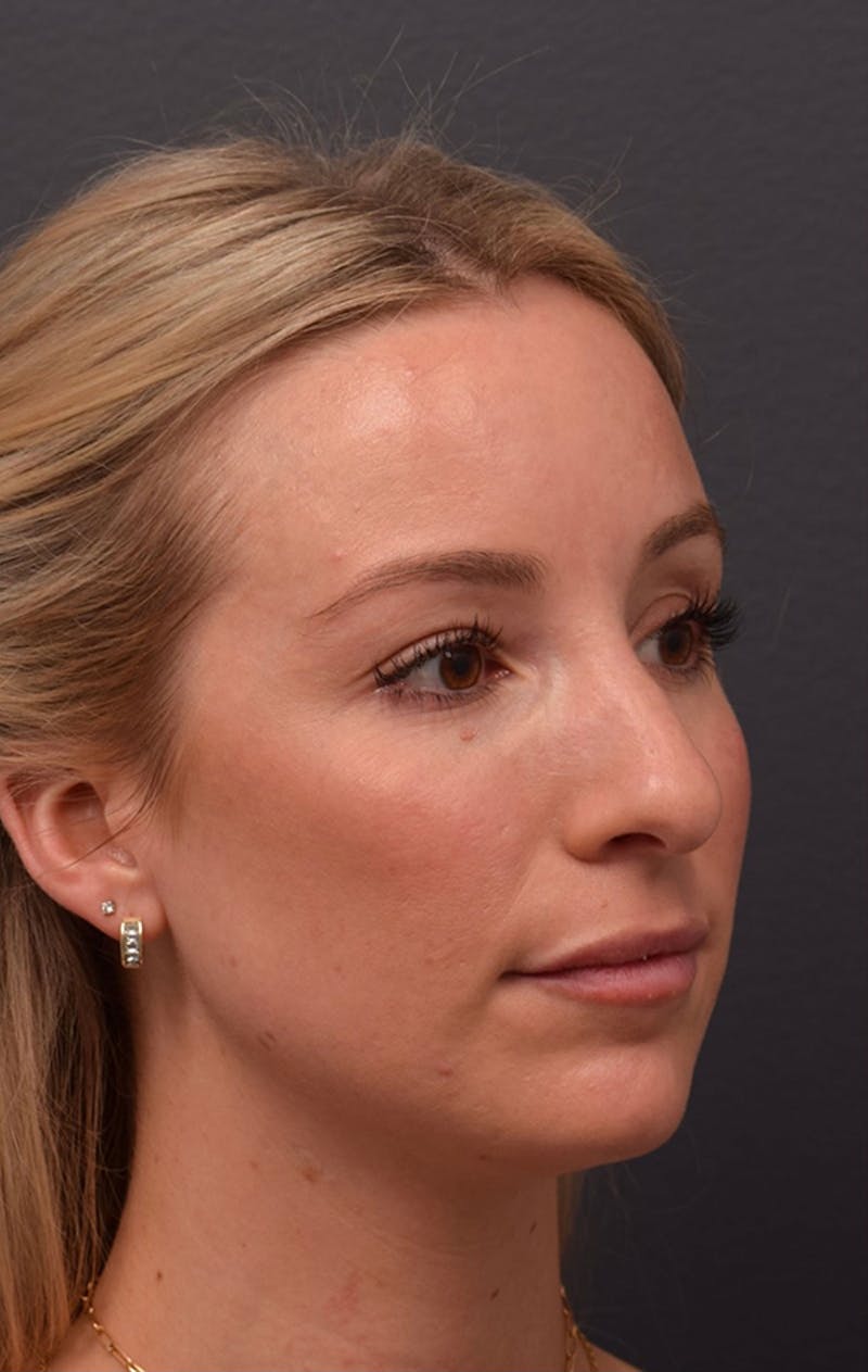 Ultrasonic Rhinoplasty Before & After Gallery - Patient 432674 - Image 5