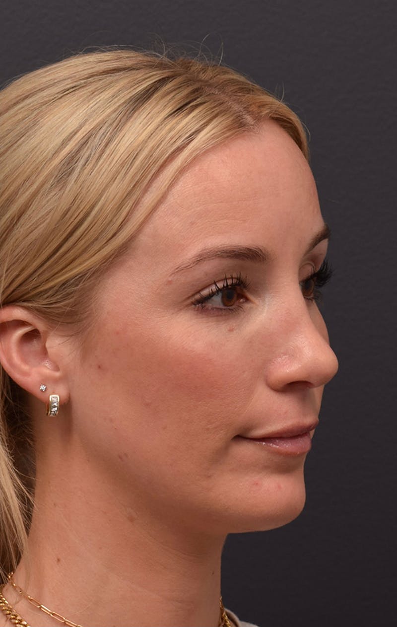 Ultrasonic Rhinoplasty Before & After Gallery - Patient 432674 - Image 6