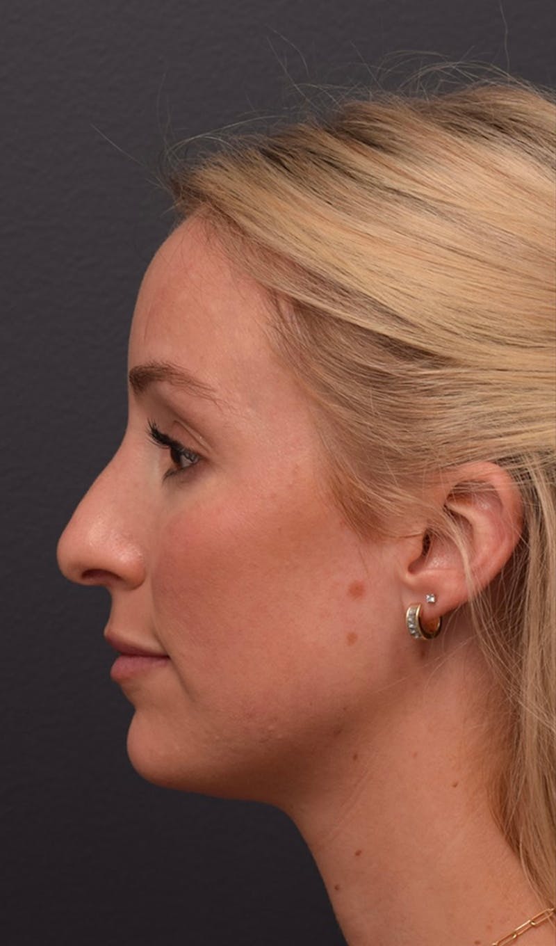 Ultrasonic Rhinoplasty Before & After Gallery - Patient 432674 - Image 7