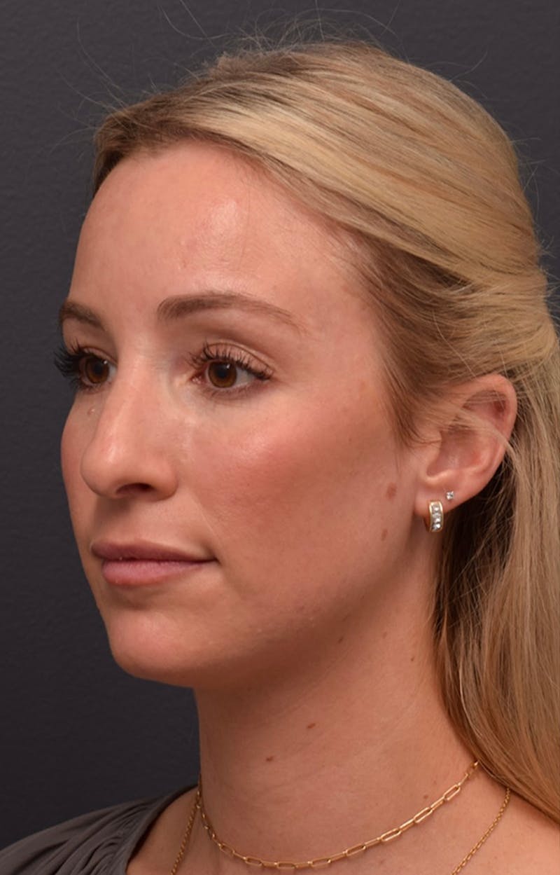 Ultrasonic Rhinoplasty Before & After Gallery - Patient 432674 - Image 9