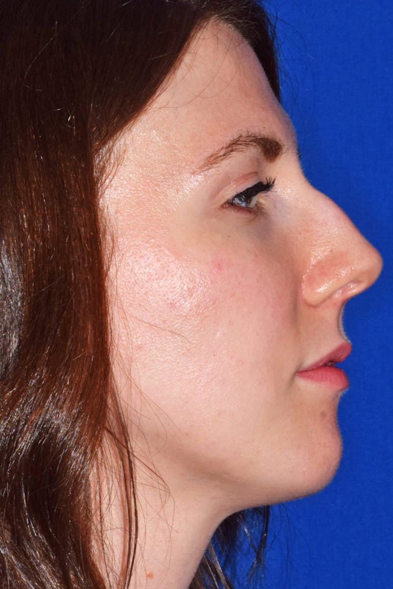 Ultrasonic Rhinoplasty Before & After Gallery - Patient 324553 - Image 1