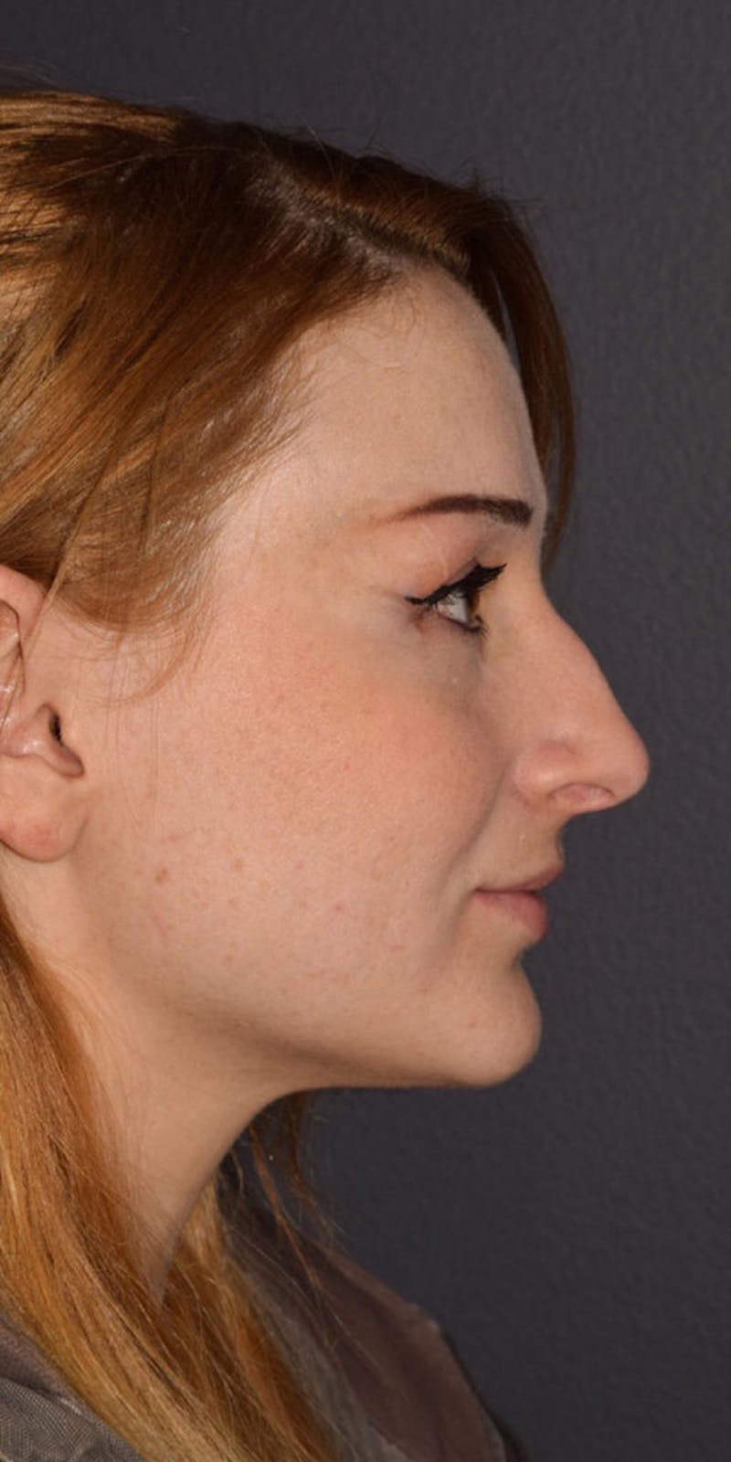 Ultrasonic Rhinoplasty Before & After Gallery - Patient 211027 - Image 1