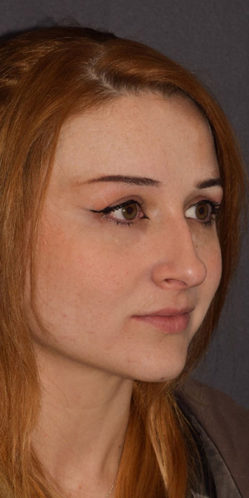Ultrasonic Rhinoplasty Before & After Gallery - Patient 211027 - Image 5