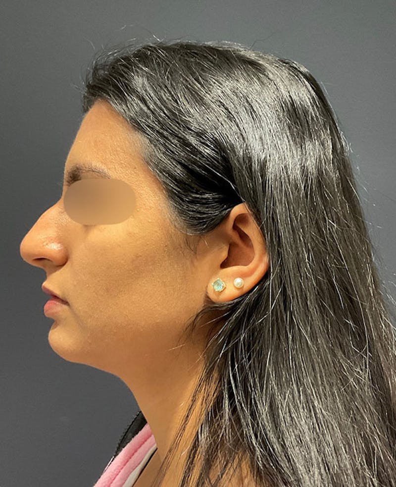 Ultrasonic Rhinoplasty Before & After Gallery - Patient 160472 - Image 5