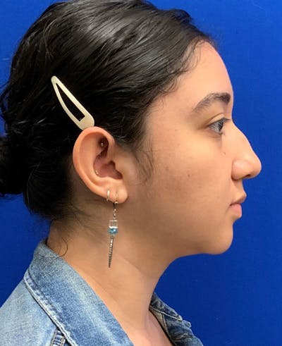Ultrasonic Rhinoplasty Before & After Gallery - Patient 327924 - Image 1
