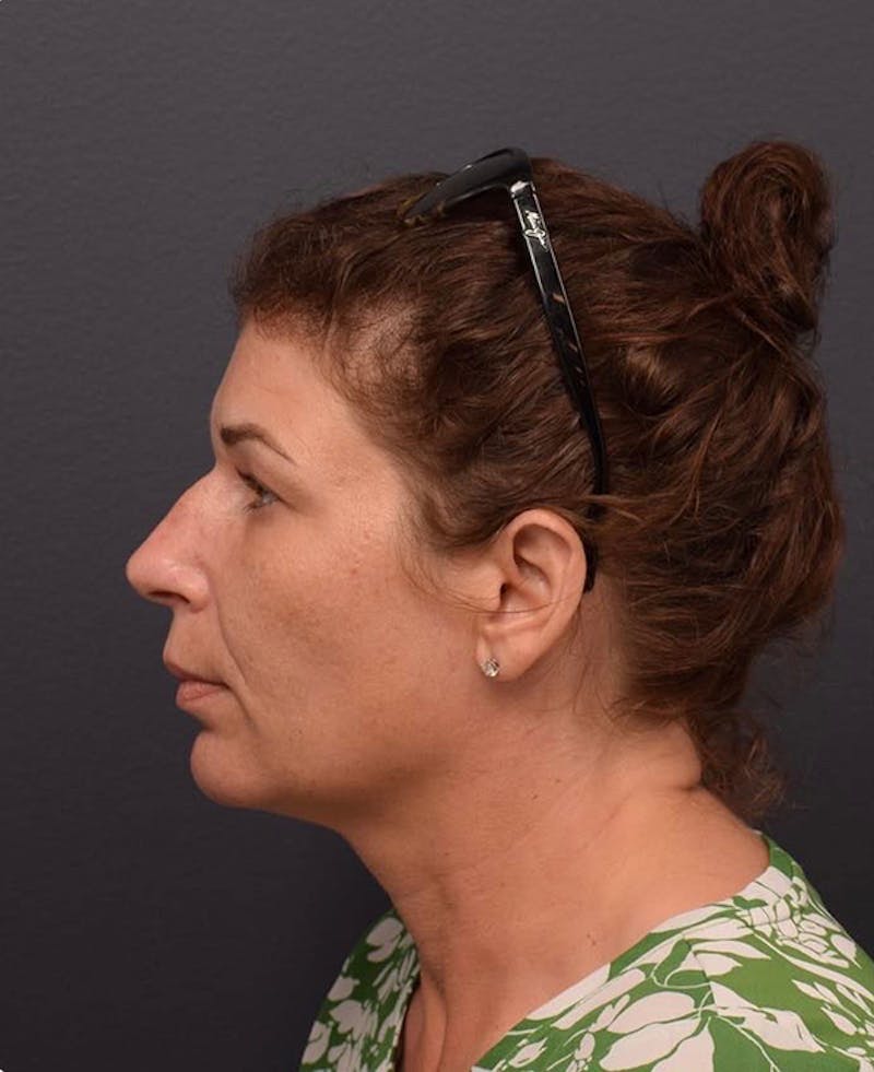 Ultrasonic Rhinoplasty Before & After Gallery - Patient 419191 - Image 1