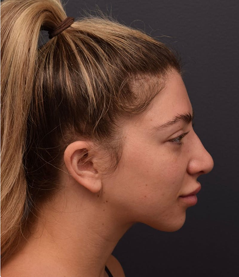 Ultrasonic Rhinoplasty Before & After Gallery - Patient 162094 - Image 1