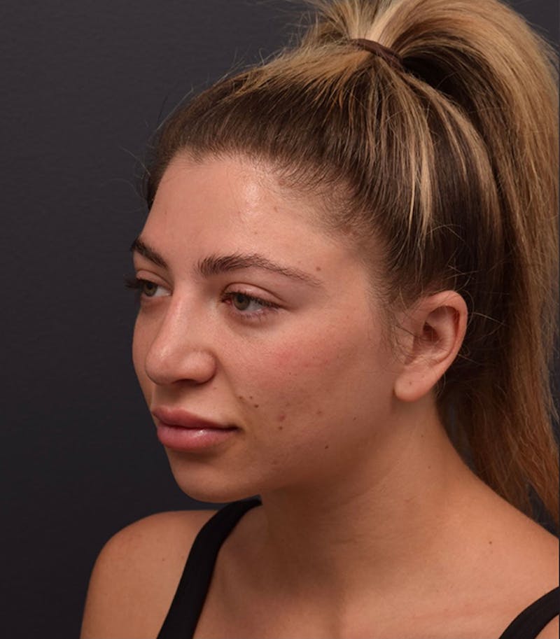 Ultrasonic Rhinoplasty Before & After Gallery - Patient 162094 - Image 7