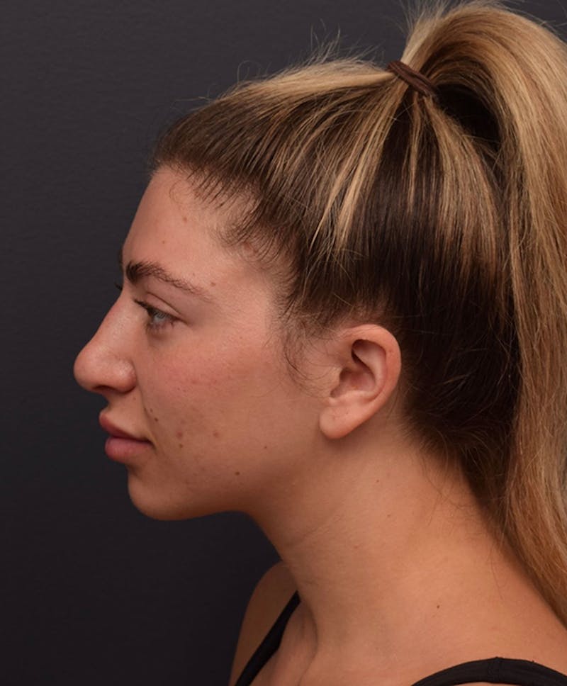 Ultrasonic Rhinoplasty Before & After Gallery - Patient 162094 - Image 9