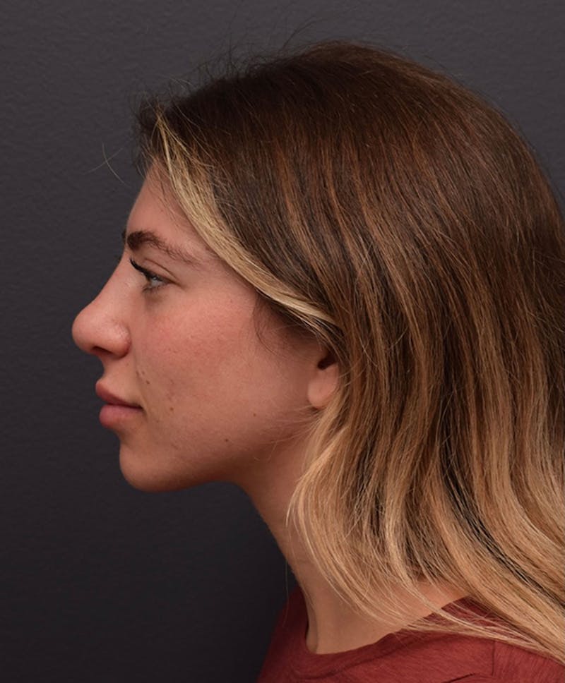 Ultrasonic Rhinoplasty Before & After Gallery - Patient 162094 - Image 10