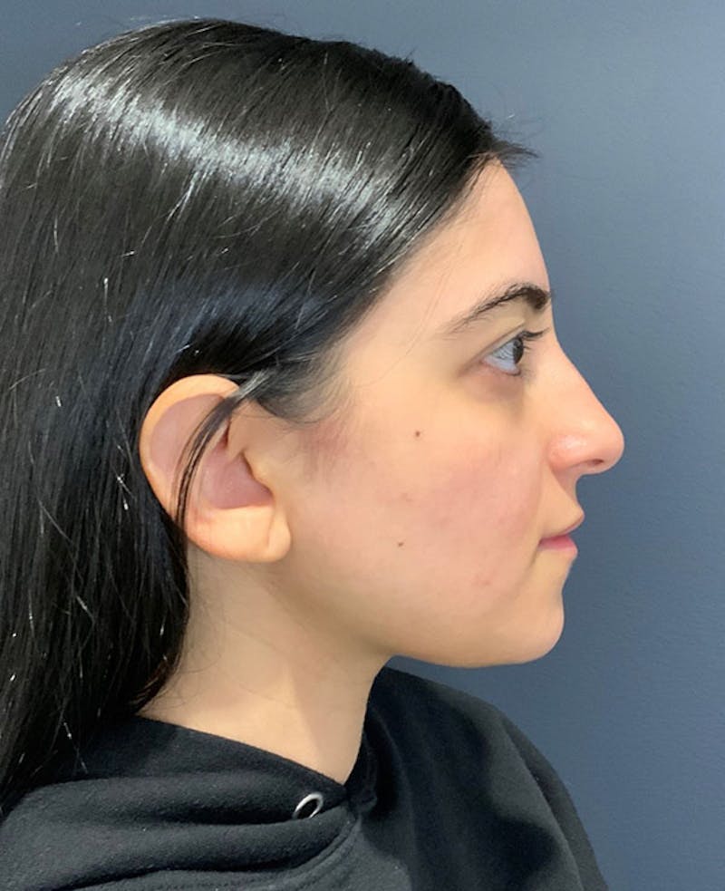 Ultrasonic Rhinoplasty Before & After Gallery - Patient 379890 - Image 1