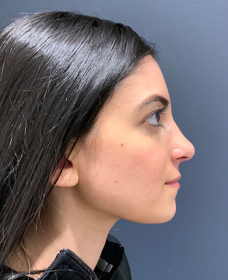 Ultrasonic Rhinoplasty Before & After Gallery - Patient 379890 - Image 2