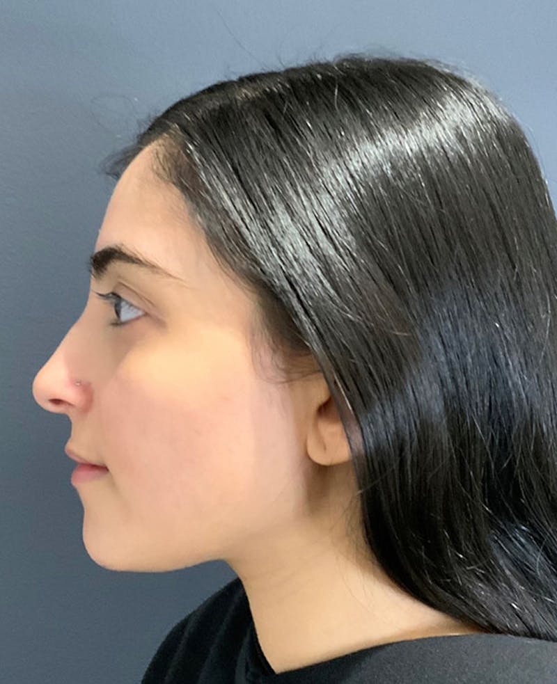 Ultrasonic Rhinoplasty Before & After Gallery - Patient 379890 - Image 9
