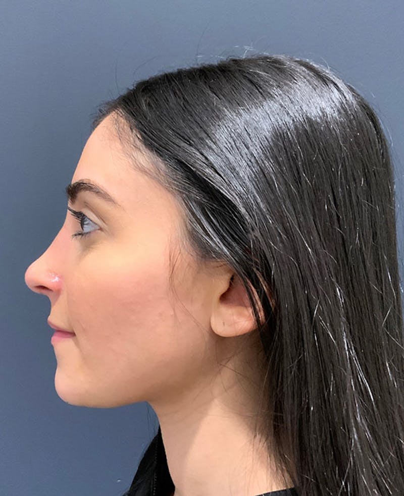 Ultrasonic Rhinoplasty Before & After Gallery - Patient 379890 - Image 10