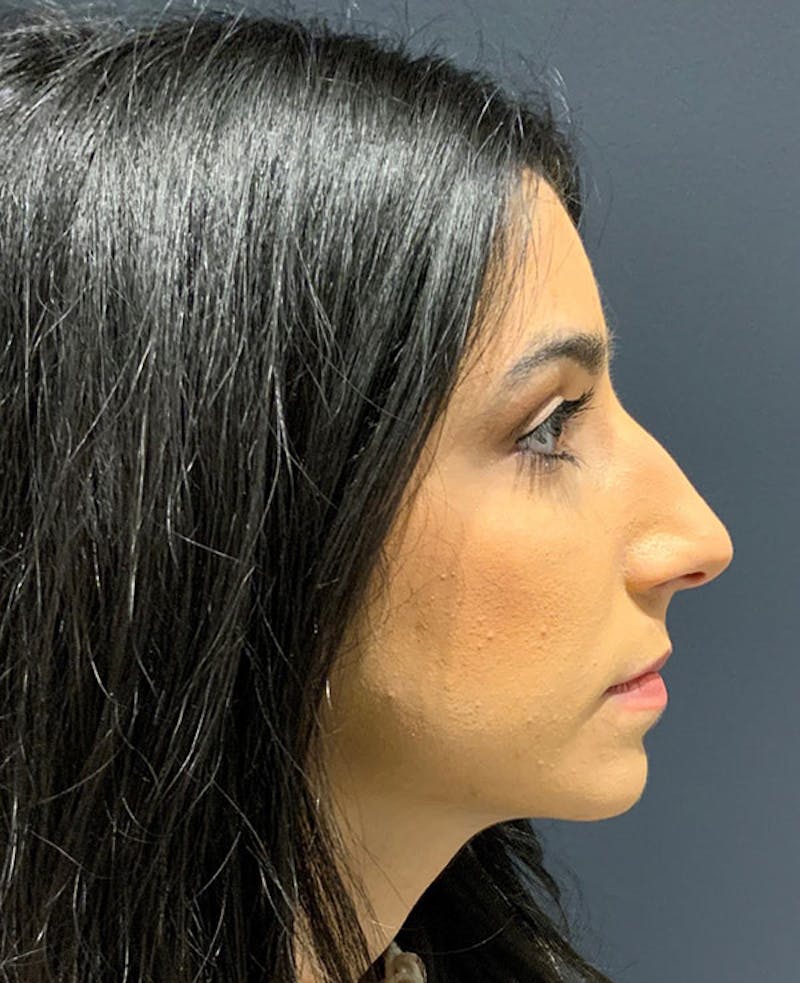 Ultrasonic Rhinoplasty Before & After Gallery - Patient 106965 - Image 1