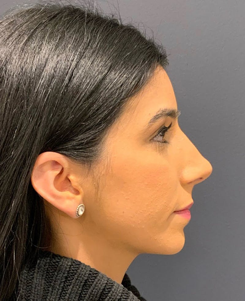 Ultrasonic Rhinoplasty Before & After Gallery - Patient 106965 - Image 2
