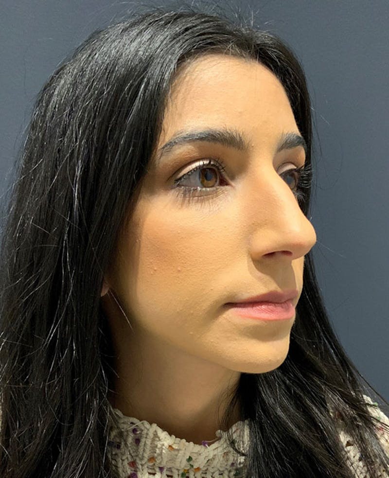 Ultrasonic Rhinoplasty Before & After Gallery - Patient 106965 - Image 5