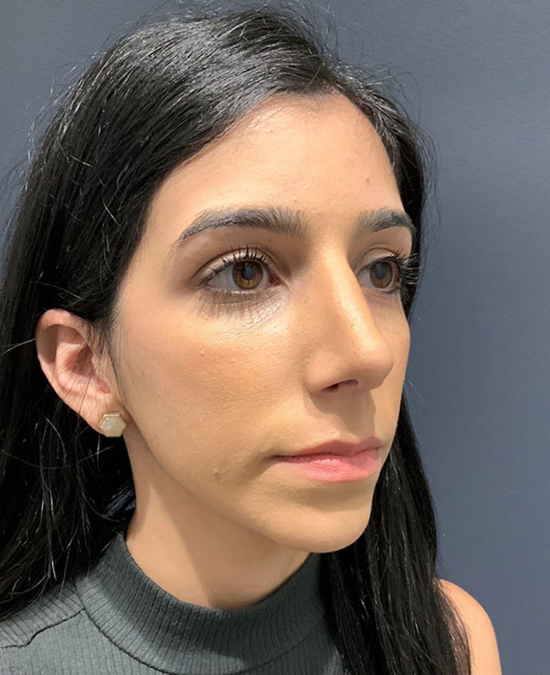 Ultrasonic Rhinoplasty Before & After Gallery - Patient 106965 - Image 6