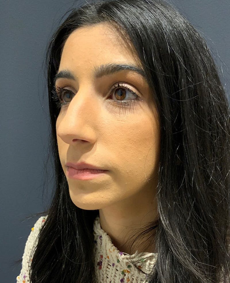 Ultrasonic Rhinoplasty Before & After Gallery - Patient 106965 - Image 7