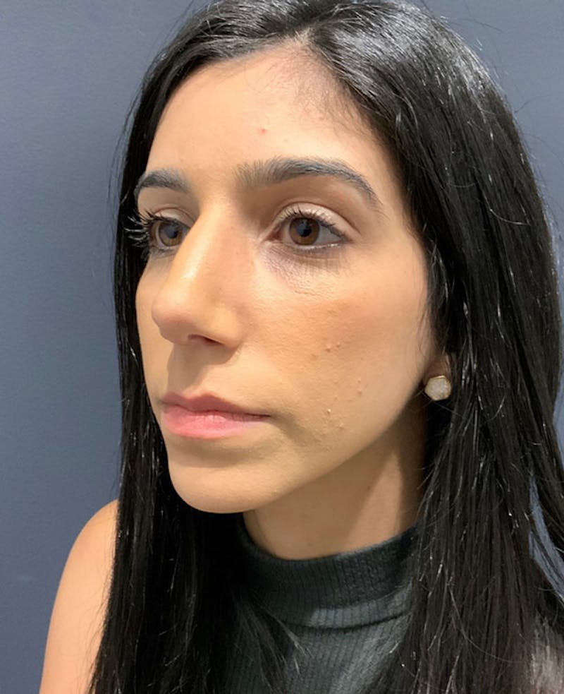 Ultrasonic Rhinoplasty Before & After Gallery - Patient 106965 - Image 8