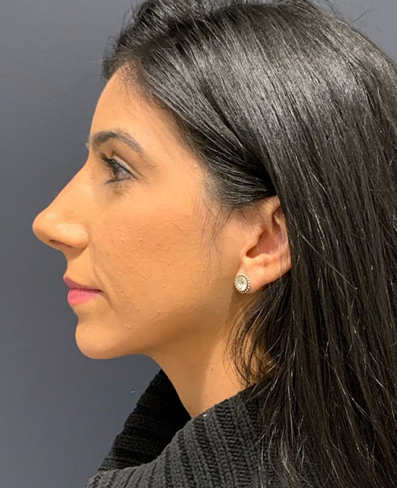 Ultrasonic Rhinoplasty Before & After Gallery - Patient 106965 - Image 10
