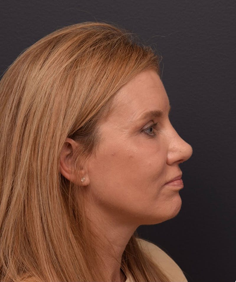 Ultrasonic Rhinoplasty Before & After Gallery - Patient 378032 - Image 2