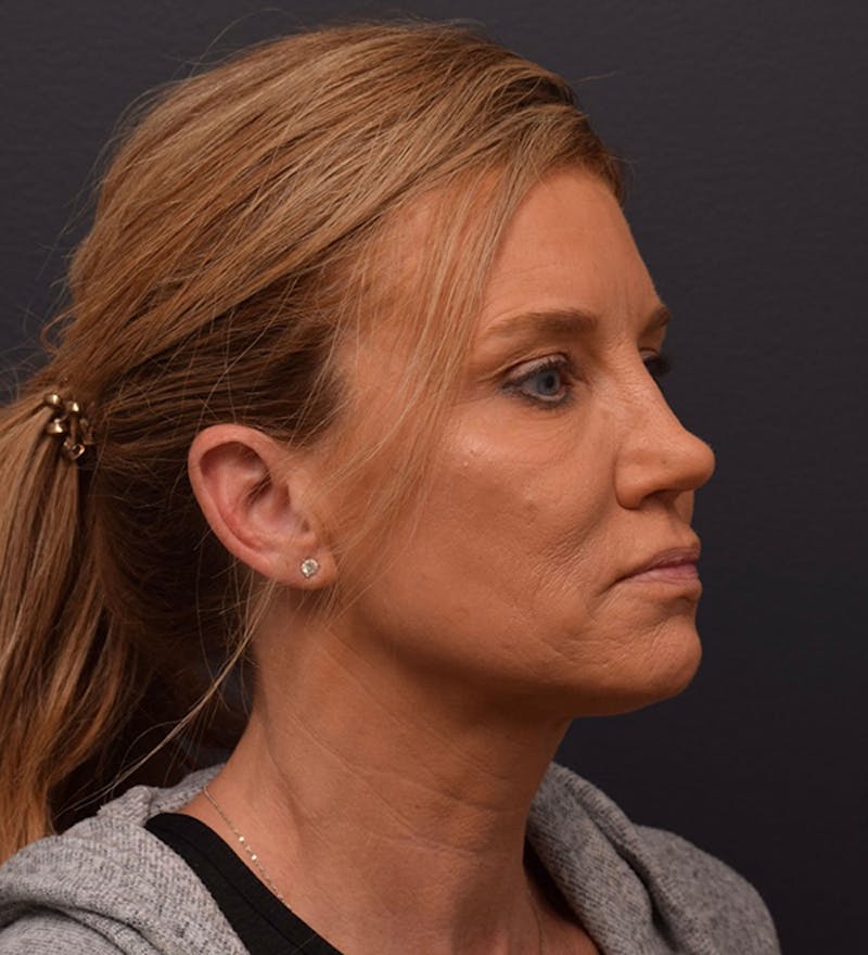 Ultrasonic Rhinoplasty Before & After Gallery - Patient 378032 - Image 5