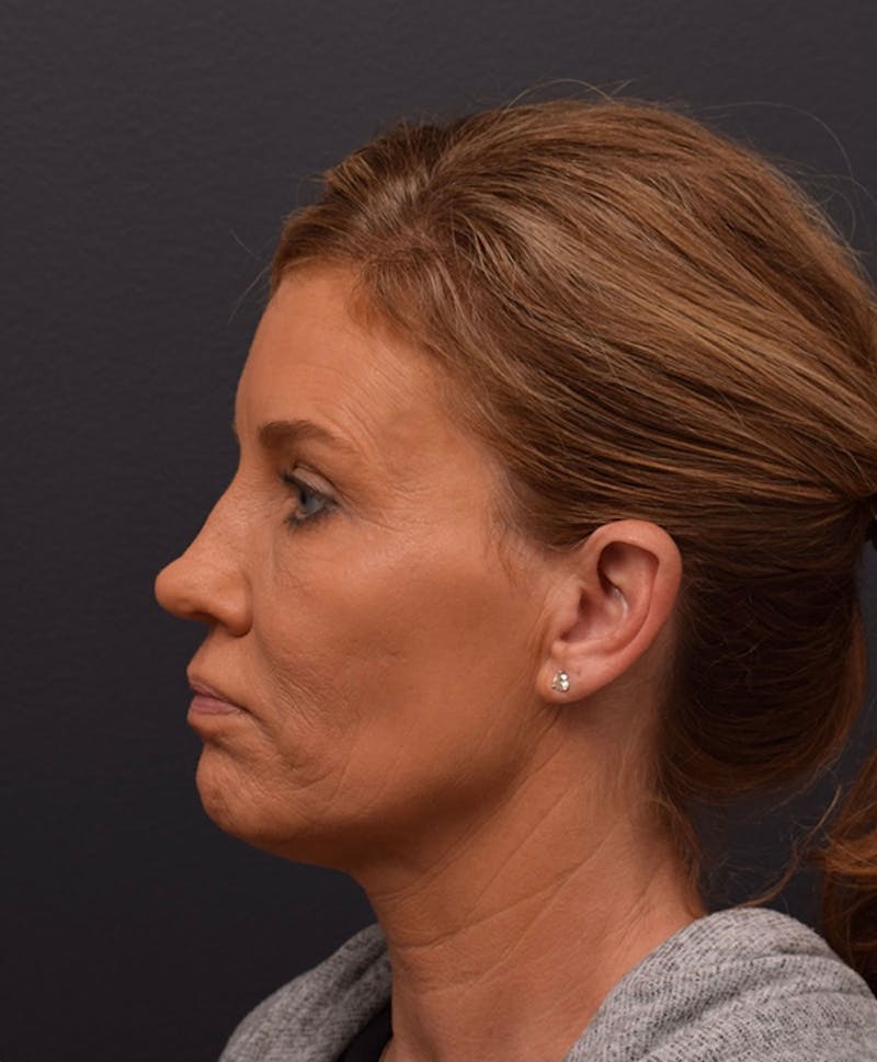 Ultrasonic Rhinoplasty Before & After Gallery - Patient 378032 - Image 9