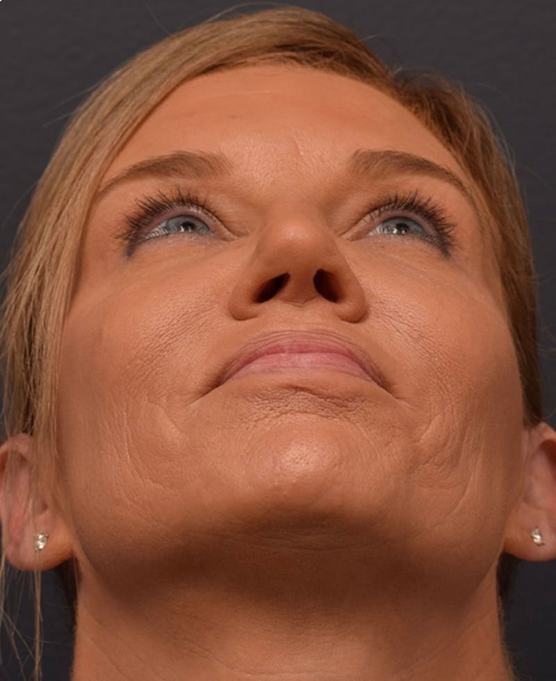 Ultrasonic Rhinoplasty Before & After Gallery - Patient 378032 - Image 11