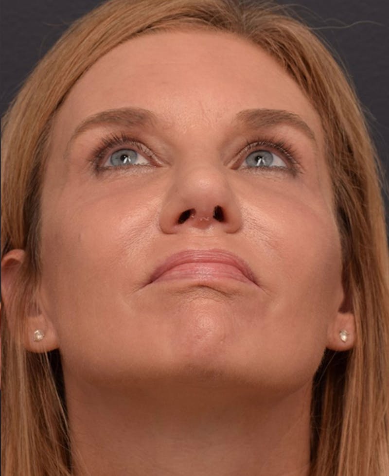 Ultrasonic Rhinoplasty Before & After Gallery - Patient 378032 - Image 12