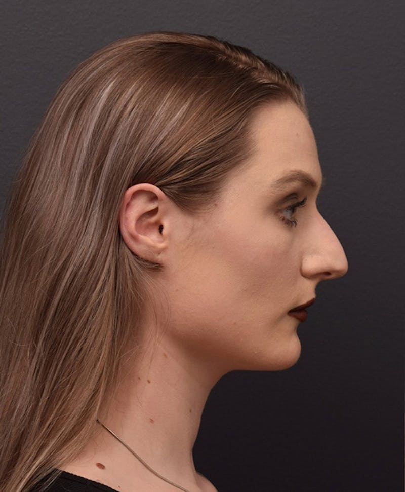 Ultrasonic Rhinoplasty Before & After Gallery - Patient 493844 - Image 1