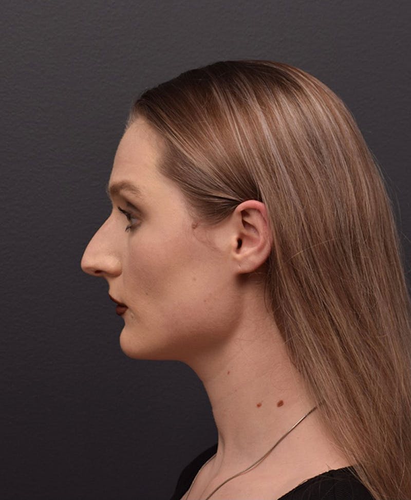 Ultrasonic Rhinoplasty Before & After Gallery - Patient 493844 - Image 7