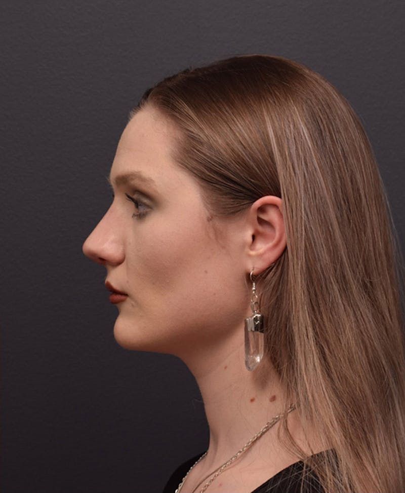 Ultrasonic Rhinoplasty Before & After Gallery - Patient 493844 - Image 8