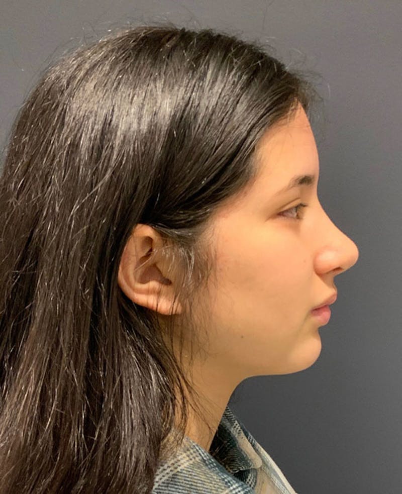 Ultrasonic Rhinoplasty Before & After Gallery - Patient 128265 - Image 2