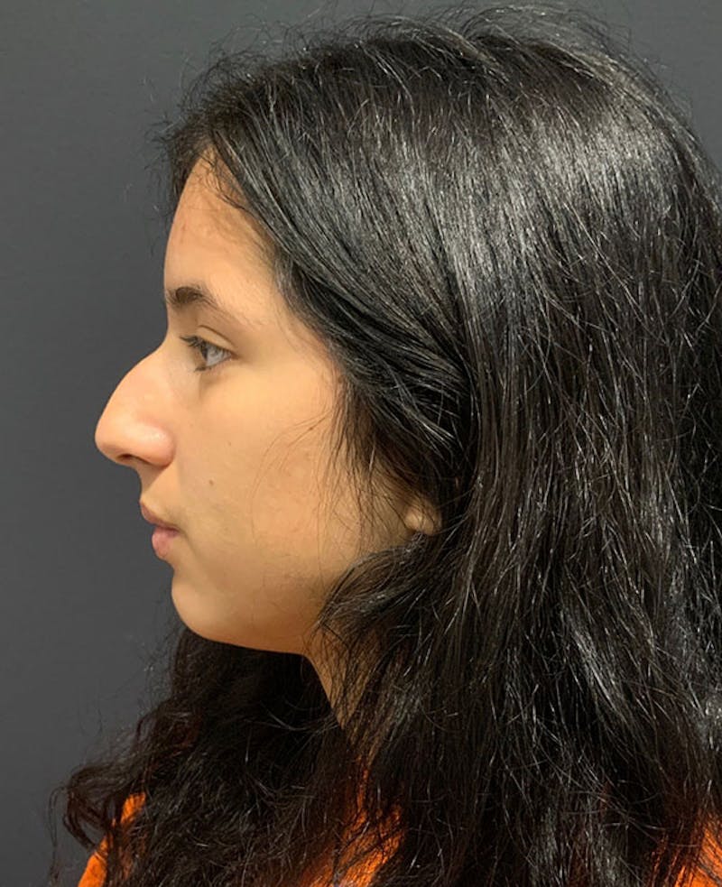 Ultrasonic Rhinoplasty Before & After Gallery - Patient 128265 - Image 9