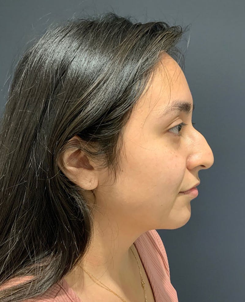 Ultrasonic Rhinoplasty Before & After Gallery - Patient 541428 - Image 1
