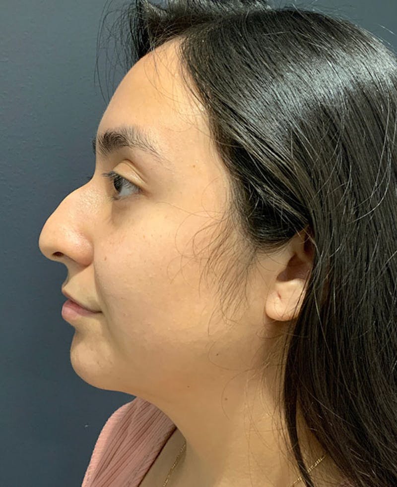 Ultrasonic Rhinoplasty Before & After Gallery - Patient 541428 - Image 9