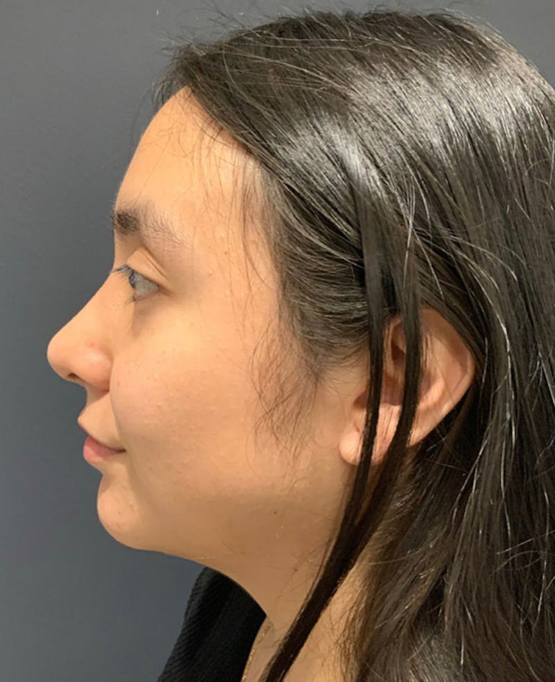 Ultrasonic Rhinoplasty Before & After Gallery - Patient 541428 - Image 10