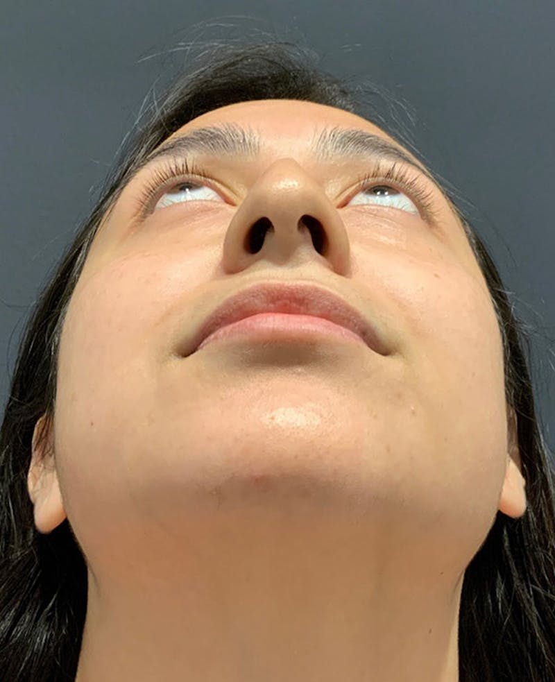 Ultrasonic Rhinoplasty Before & After Gallery - Patient 541428 - Image 11