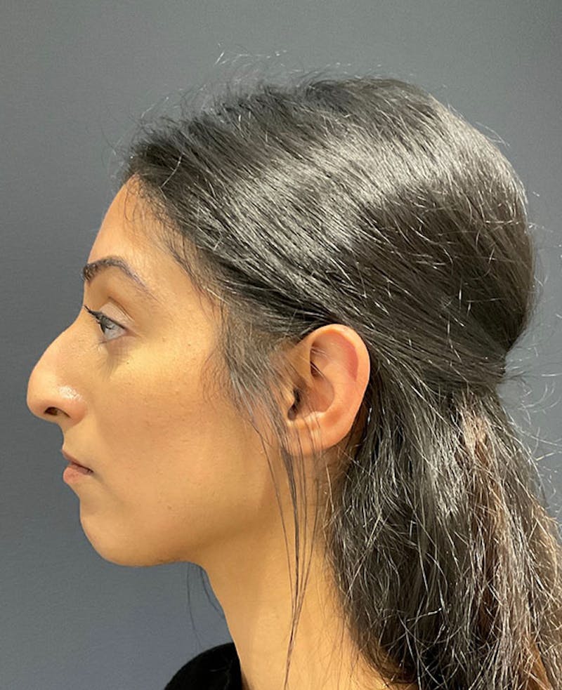 Ultrasonic Rhinoplasty Before & After Gallery - Patient 113010 - Image 1