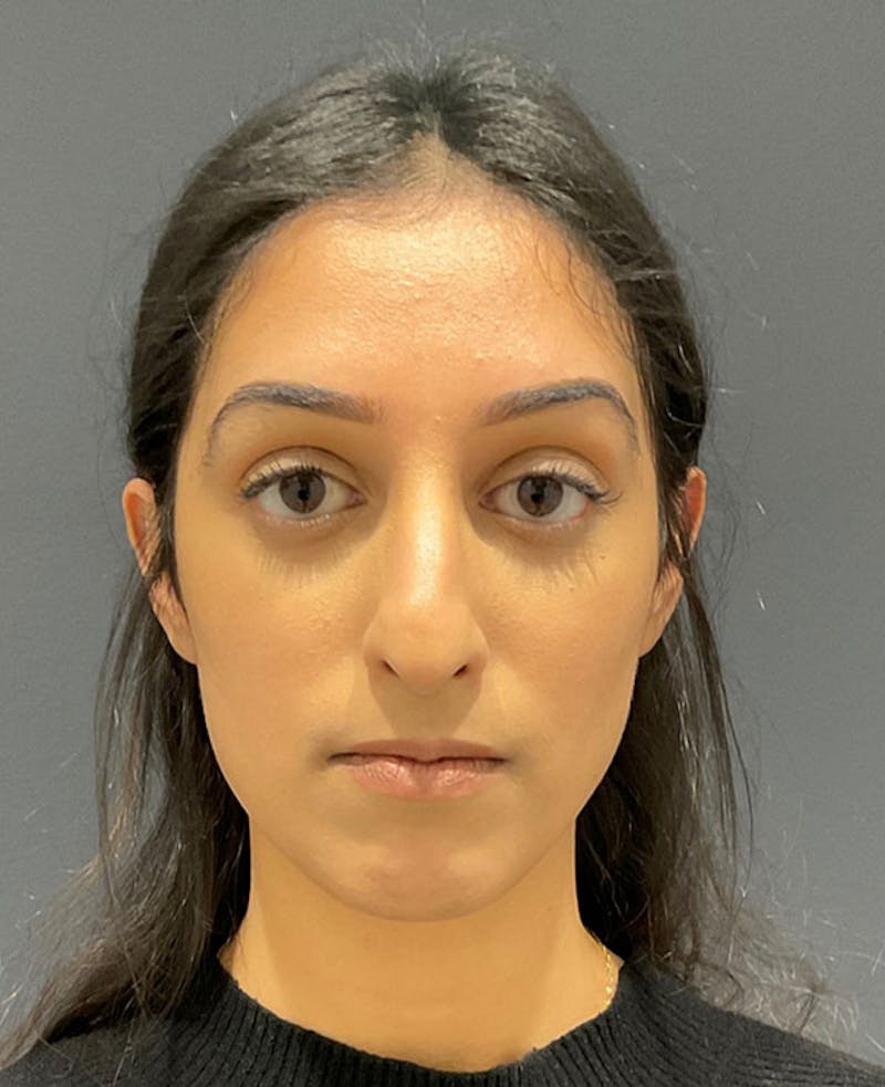 Ultrasonic Rhinoplasty Before & After Gallery - Patient 113010 - Image 3
